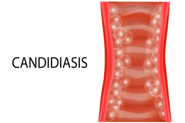 vaginal mucosa of the patient of the candidiasis clipart
