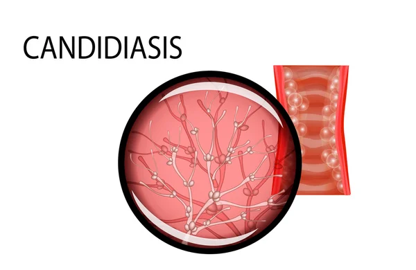 Vaginal mucosa of the patient of the candidiasis — Stock Vector