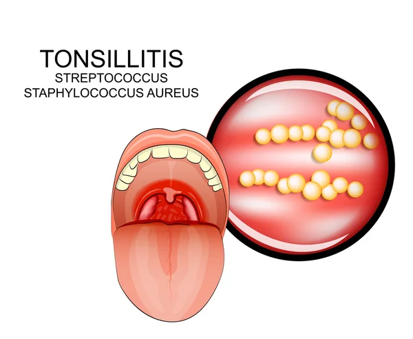 Inflamación enfermedades de la garganta — Vector de stock