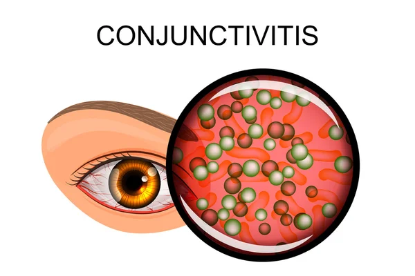 Ögat lider av konjunktivit och passform — Stock vektor