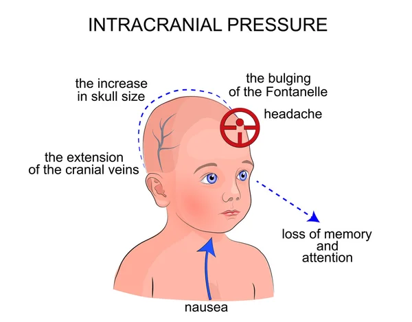 Os sintomas da pressão intracraniana em crianças — Vetor de Stock