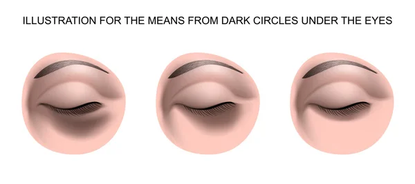 Темные круги под глазами — стоковый вектор