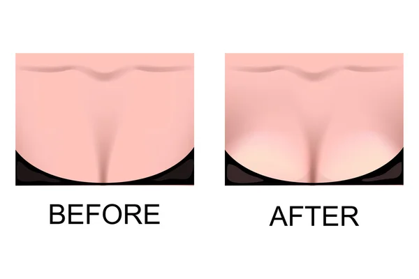 L'augmentation mammaire. chirurgie plastique — Image vectorielle