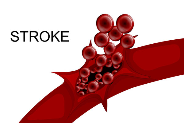 hemorrhagic stroke. insult. rupture of the vessel