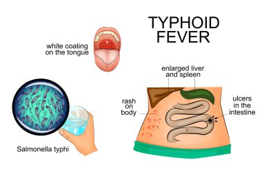 typhoid fever. infographics. pathogen. clipart