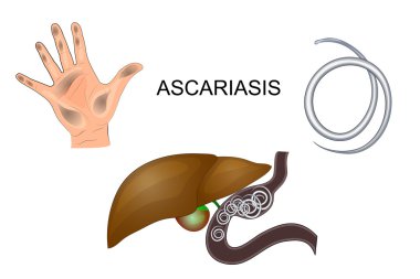 dirty hands, roundworm obstruction of the liver clipart
