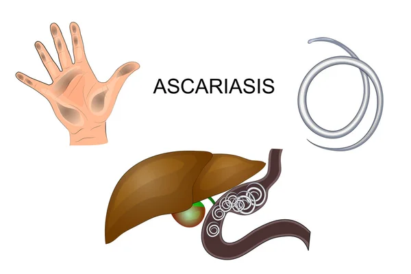汚れた手、肝臓の回虫閉塞 — ストックベクタ