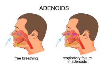 adenoiditis, solunum yetmezliği