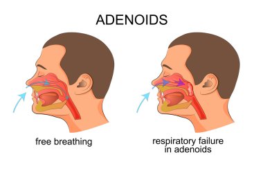 adenoiditis, respiratory failure clipart