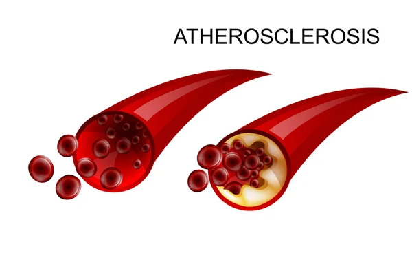 El vaso sano y aterosclerótico — Vector de stock