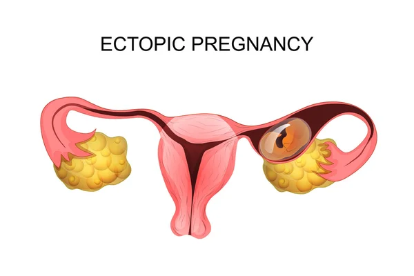 Útero con embarazo ectópico — Vector de stock