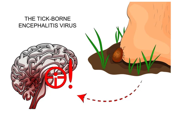 Ο ιός της tick-borne εγκεφαλίτιδα. τσιμπούρι — Διανυσματικό Αρχείο
