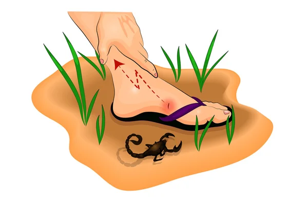 Ilustração de uma picada de escorpião no pé —  Vetores de Stock