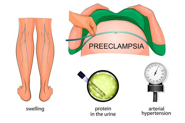 Eclampsia 임신에서의 증상 — 스톡 벡터