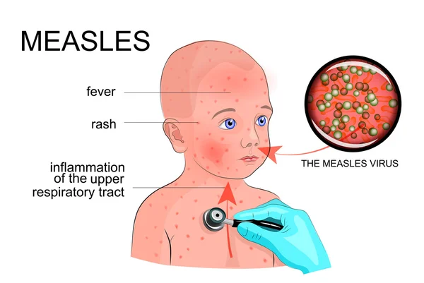 The boy with the symptoms of rubella or measles — Stock Vector