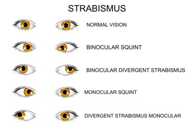 eyes. types of strabismus clipart
