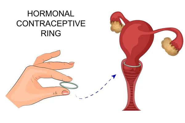 Anillo anticonceptivo hormonal — Archivo Imágenes Vectoriales