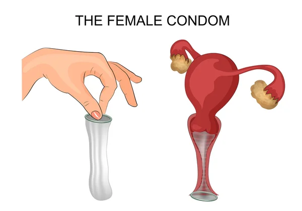 Жіночий презерватив, матка, вагіна — стоковий вектор