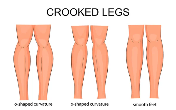 Curvatura das pernas —  Vetores de Stock