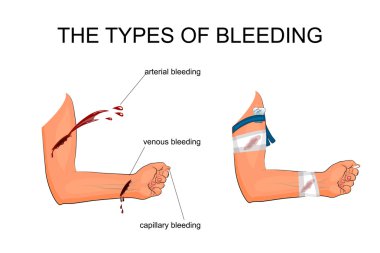 the types of bleeding clipart