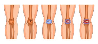 damage to the knee joint clipart