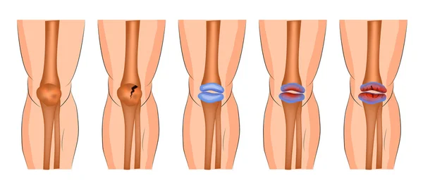 Daño en la articulación de la rodilla — Archivo Imágenes Vectoriales