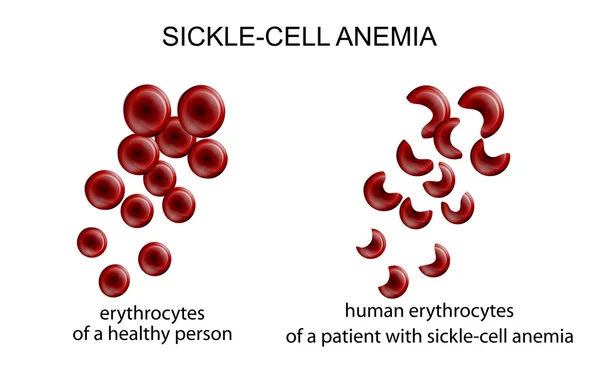 Anemia sel sakit. - Stok Vektor