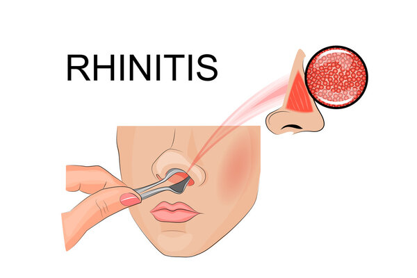 осмотр полости носа
