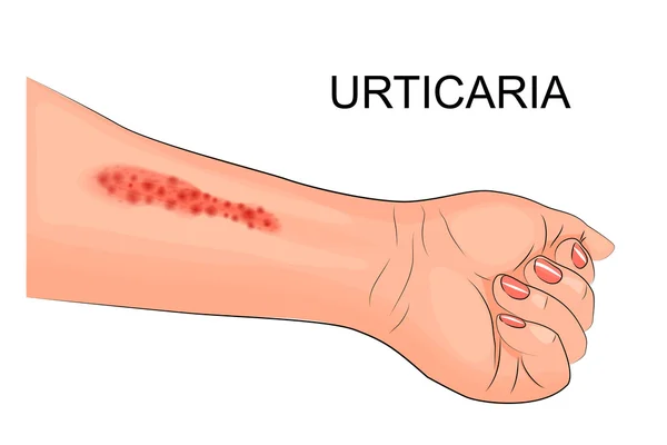 Χέρι ο ασθενής πάσχει από κυψέλες — Διανυσματικό Αρχείο