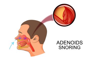 adenoids cause snoring clipart