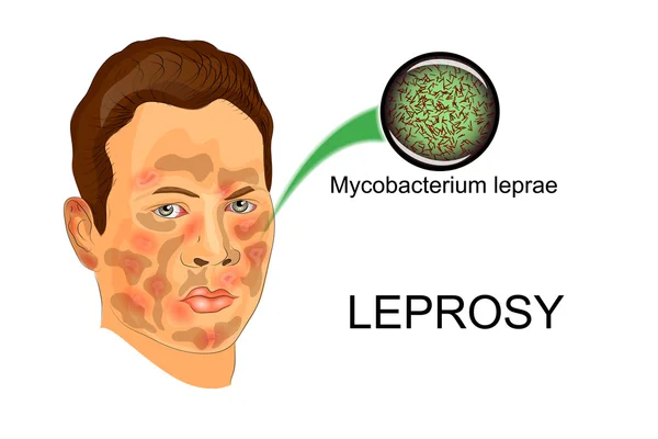 Le visage du patient atteint de lèpre — Image vectorielle