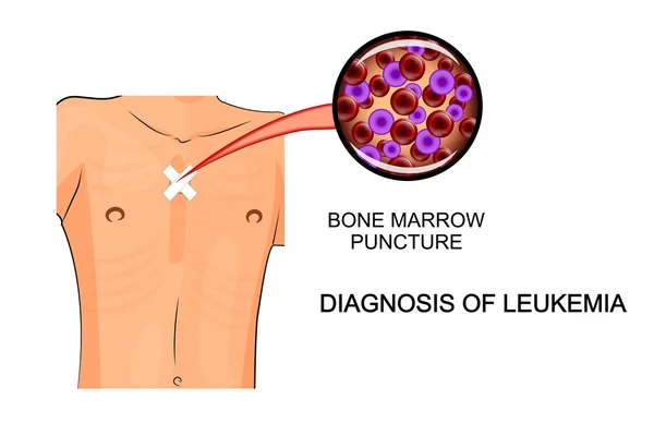 Leucemia por punção da medula óssea — Vetor de Stock