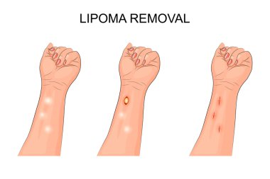 Lipom. Lipom üzerindeki önkol kaldırılması