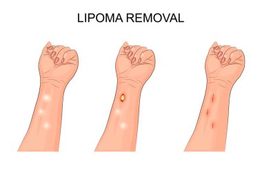 lipoma. removal of lipoma on forearm clipart