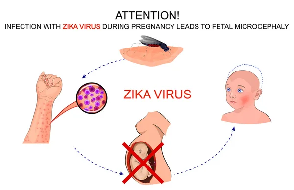 A terhes nők számára a zika vírus-fertőzés következménye — Stock Vector