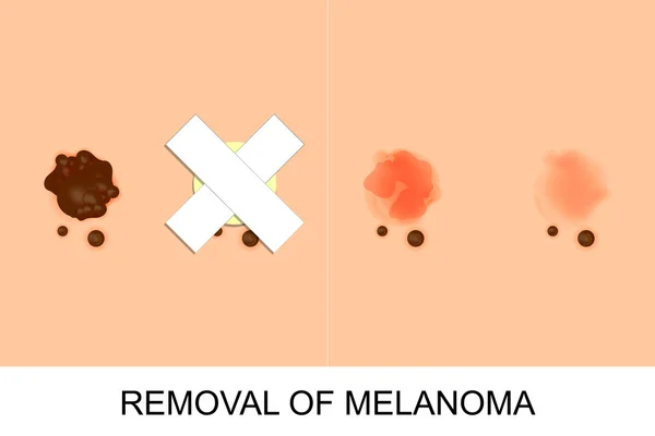 Removal of melanoma — Stock Vector