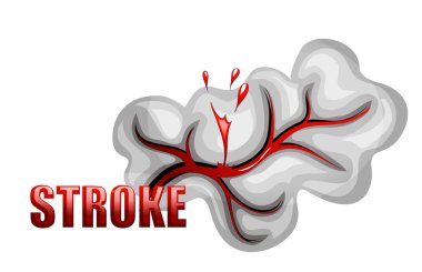 hemorrhagic stroke. insult. rupture of the vessel clipart