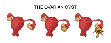 uterus and ovarian cyst clipart