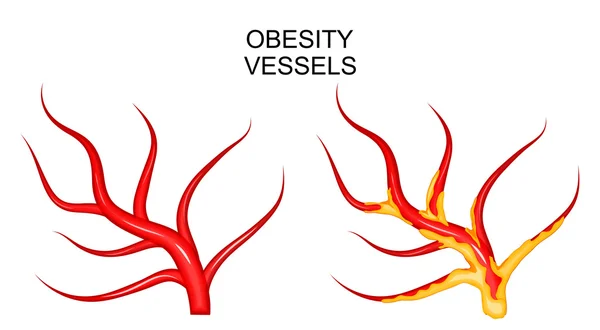 Navi sane ed obese — Vettoriale Stock