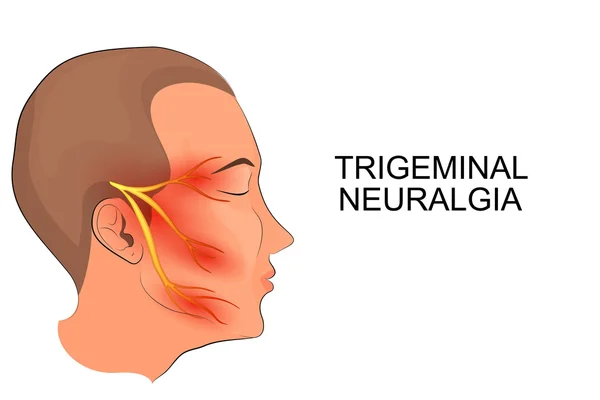 Trigeminal neuralgia. neuroscience — Stock Vector