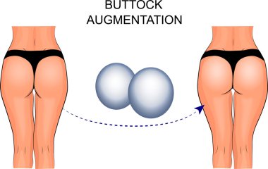 kadın kalça implantları, kalça büyütme
