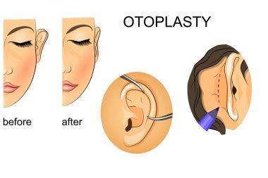 plastic surgery. correction of protruding ears clipart