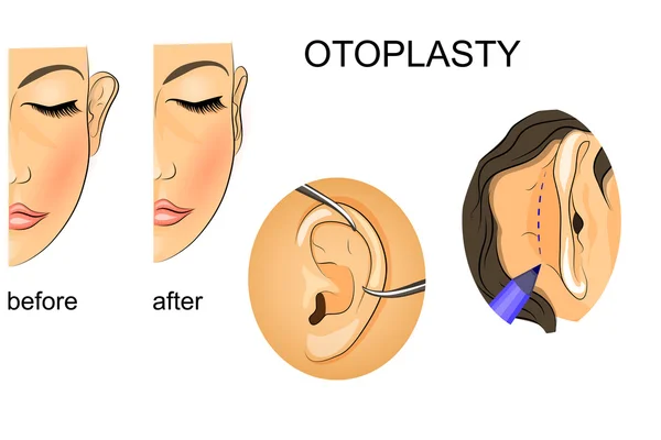 Plastische chirurgie. correctie van uitstaande oren — Stockvector