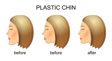 plastic surgery of the chin.before and after clipart