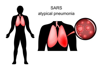 SARS. inflamed lungs and the causative agent clipart