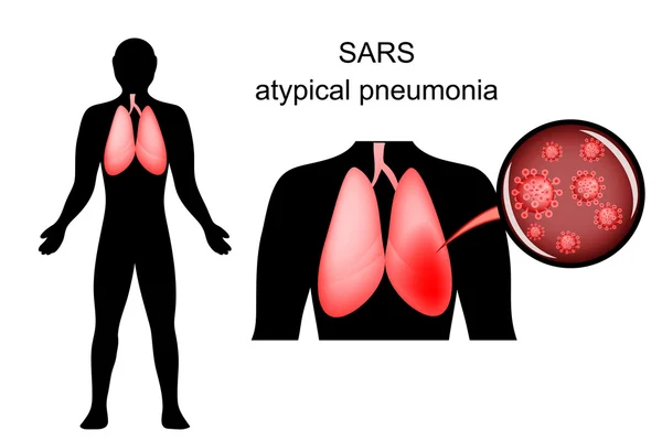 SARS. inflamed lungs and the causative agent — Stock Vector