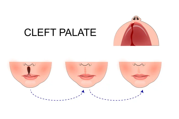 Cleft palate in a child. plastic surgery. reconstruction of the — Stock Vector