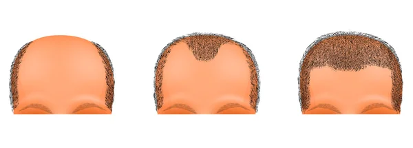 Cabeza masculina, pérdida de cabello sufre. trasplante de cabello — Vector de stock