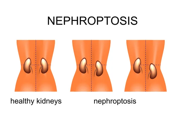 The omission of kidneys with different degree of complexity — Stock Vector