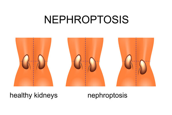 the omission of kidneys with different degree of complexity